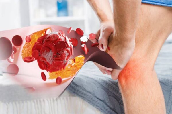 Uric Acid