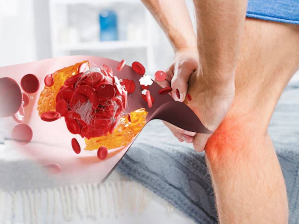 Uric Acid