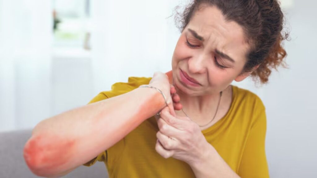 High Uric Acid Symptoms
