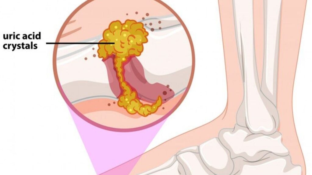 Symptoms of Increased Uric Acid